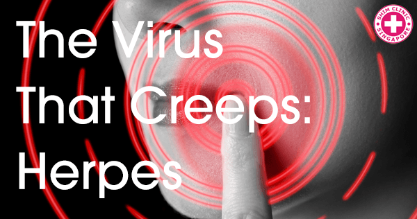 The virus that creeps: Herpes simplex