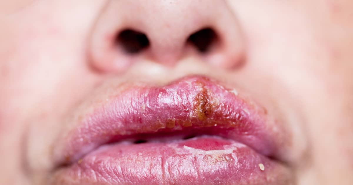 How Hazardous Is Herpes?