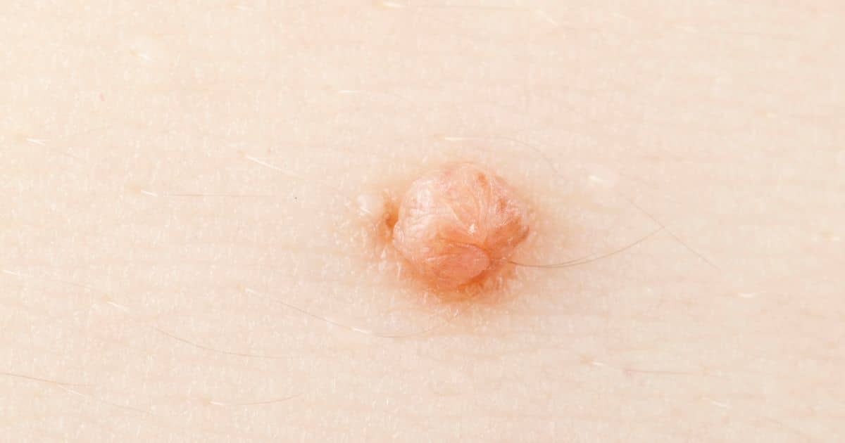Are Warts Always Caused By HPV?