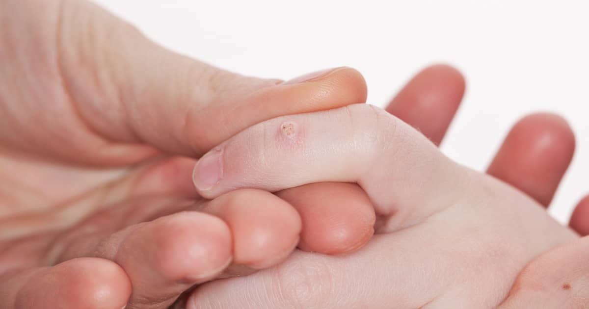 Are Genital Warts and Skin Tags the Same Thing?