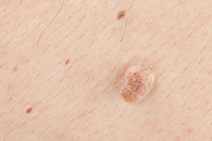 Understanding Warts and Verrucas: How HPV Plays a Major Role in Skin Health