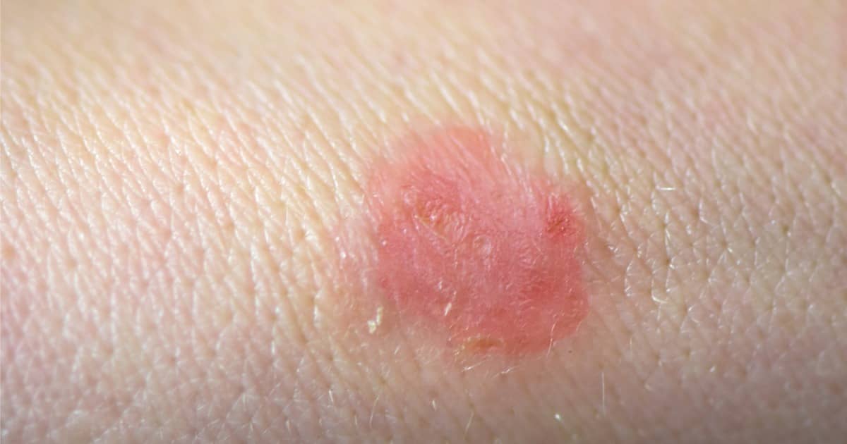 First Case of Sexually Transmitted Fungal Infection Reported: What You Need to Know