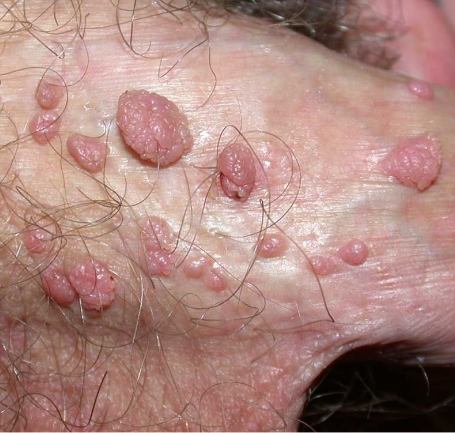 Genital Warts