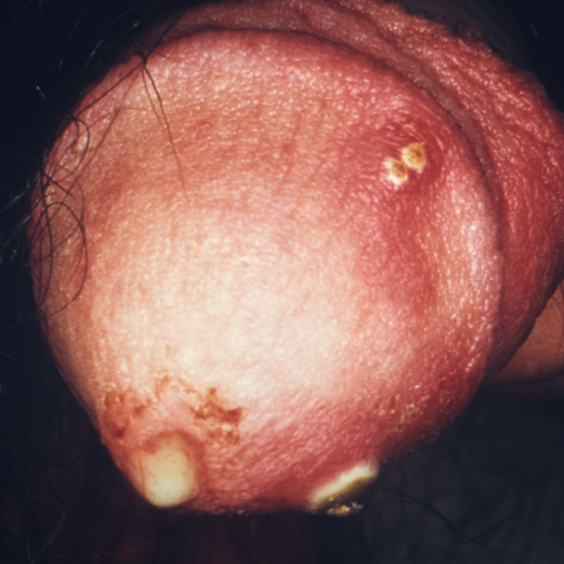 Gonorrhoea - pus discharge from male sex organ