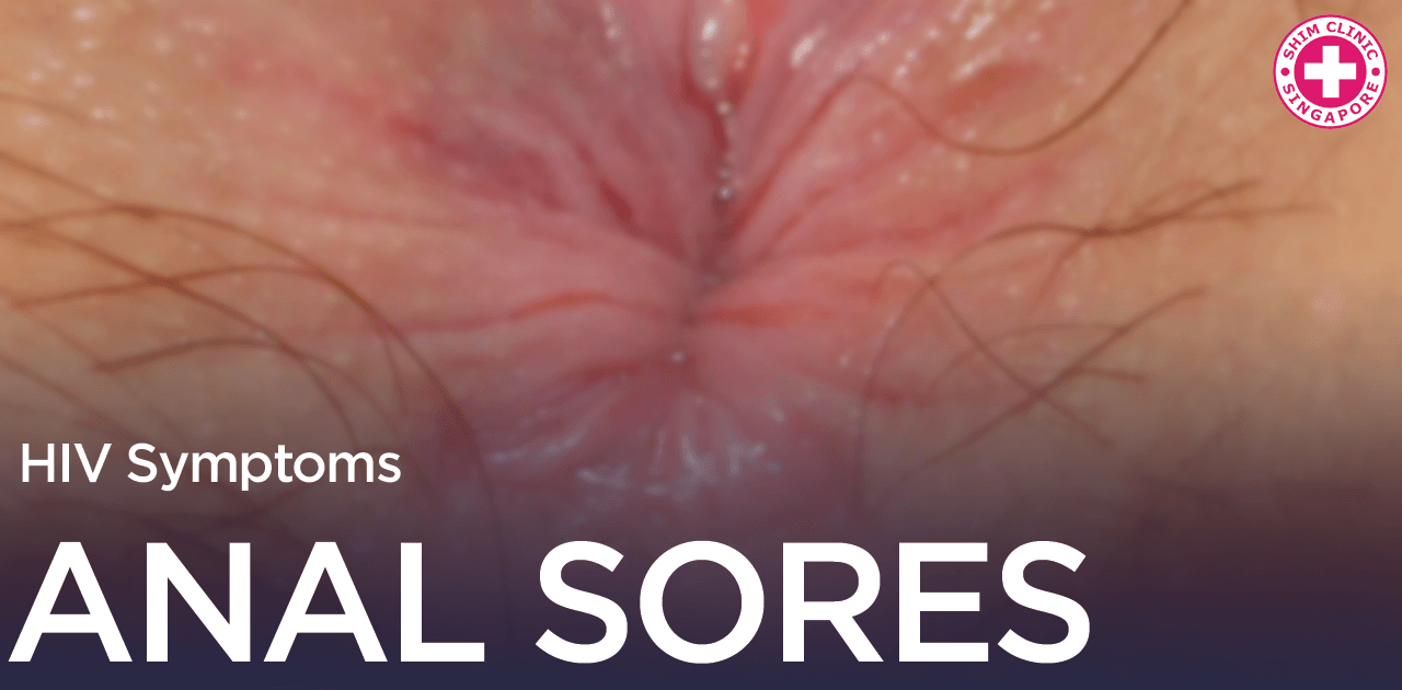 HIV Symptoms Anal Sores Singapore