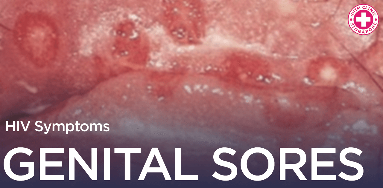 HIV Symptoms Genital Sores Singapore