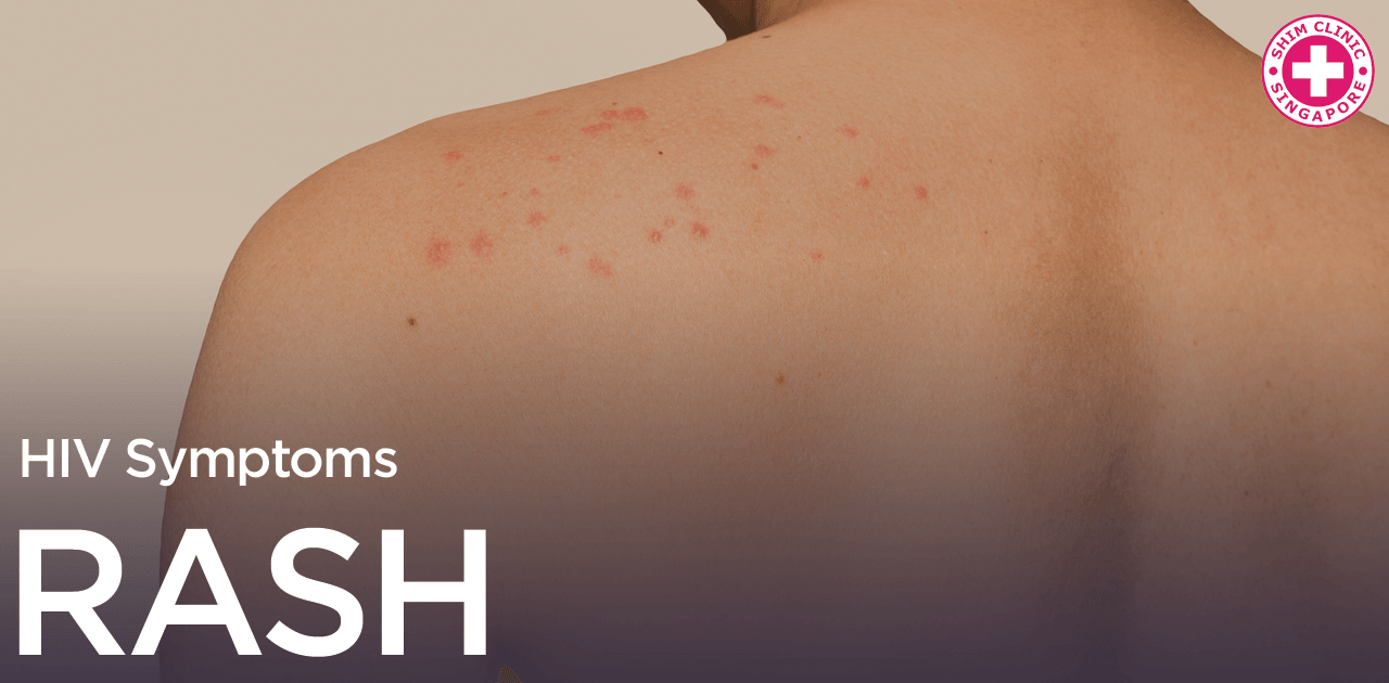 hiv-symptoms-rash-singapore Singapore | hiv-symptoms-rash-singapore | Shim  Clinic