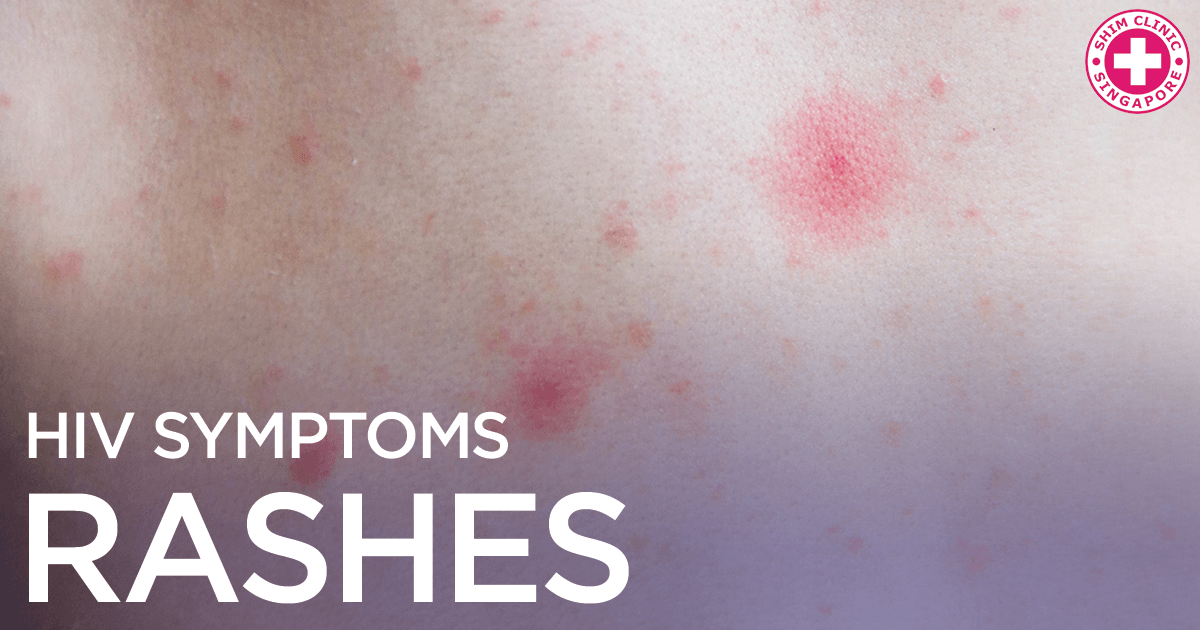 A rash is a possible symptom of an acute HIV infection. 