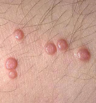 Molluscum Contagiosum