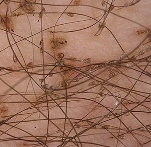 Pubic lice crabs