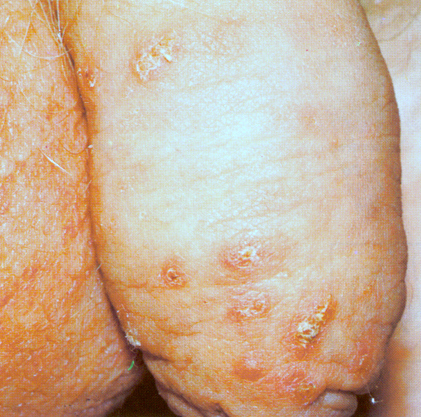 Syphilis chancre penis