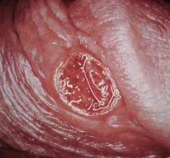 Syphilis chancre penis