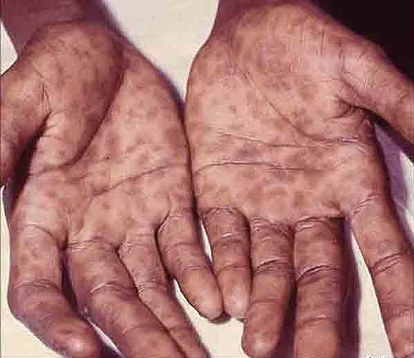 Syphilis - skin rash